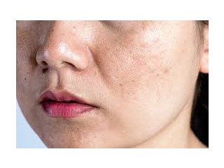 Benzaclin Your result for Acne- Purchase Securely for Clearer Skin