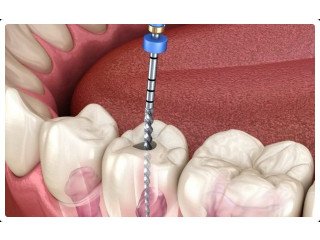 Expert Root Canal Melbourne Treatments