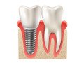 looking-for-top-quality-dental-implants-in-perth-small-0