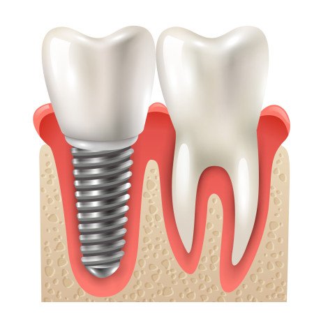 looking-for-top-quality-dental-implants-in-perth-big-0