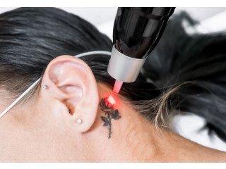 Book a Laser Tattoo Removal Session in Sydney